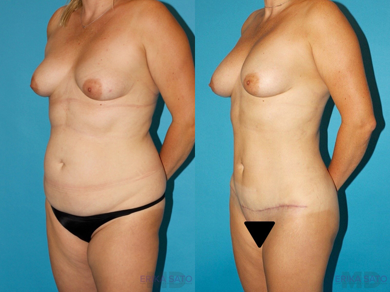 Mommy Makeover case #6505