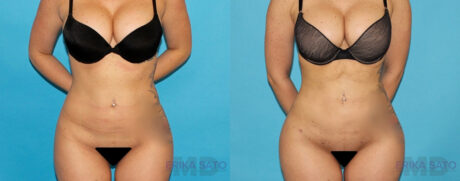 Liposuction case #4728