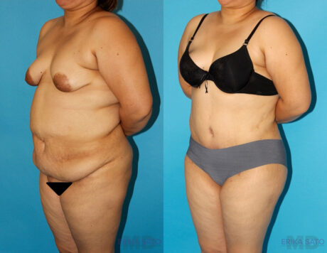 Tummy Tuck case #7088