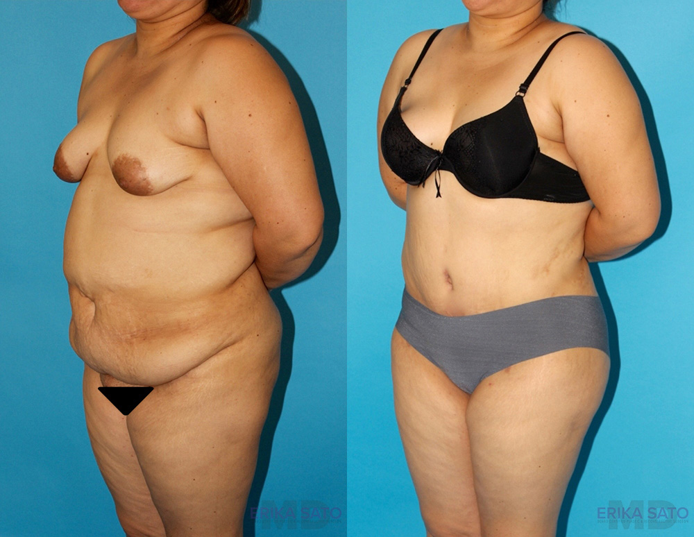 Tummy Tuck case #7088