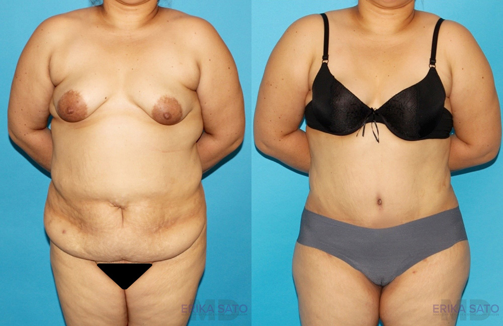 Tummy Tuck case #7088