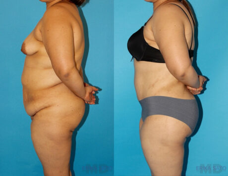 Tummy Tuck case #7088