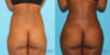 Brazilian Butt Lift case #4727 slider thumbnail