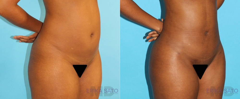 Brazilian Butt Lift case #4727