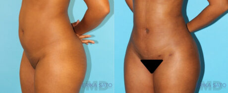 Brazilian Butt Lift case #4727