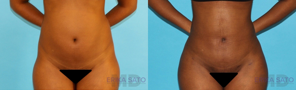 Brazilian Butt Lift case #4727