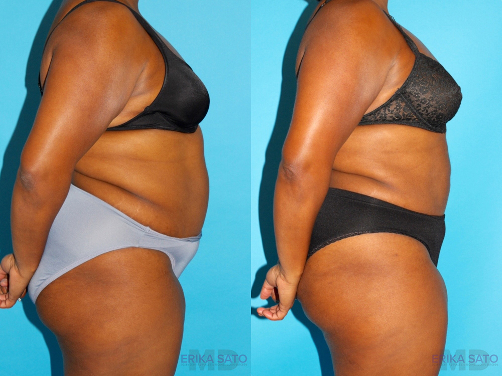 Liposuction case #5885