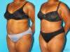 Liposuction case #5885 slider thumbnail