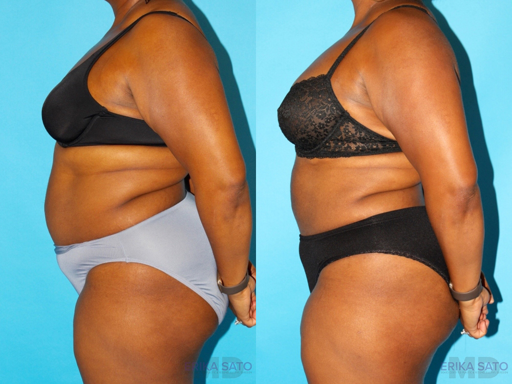 Liposuction case #5885