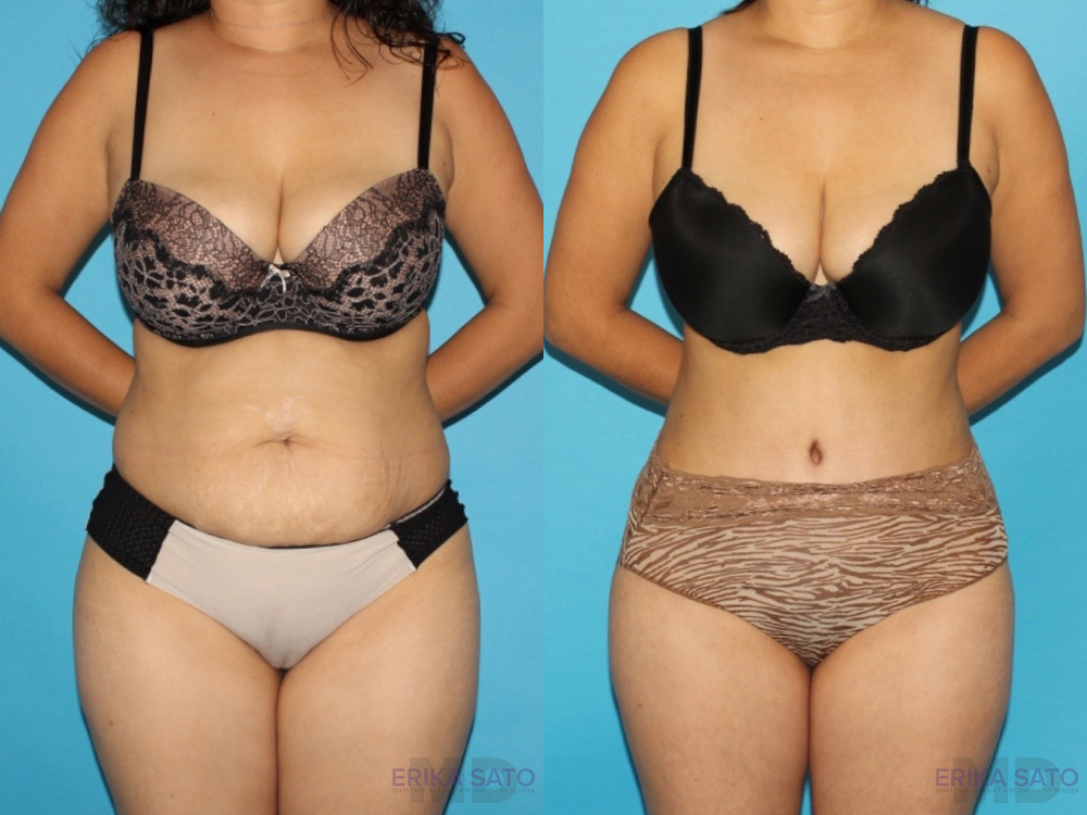 Tummy Tuck case #7166
