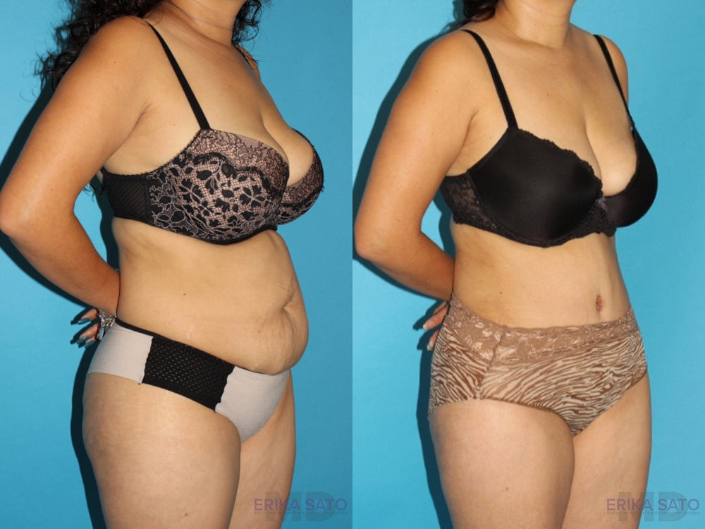 Tummy Tuck case #7166