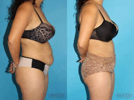 Tummy Tuck case #7166