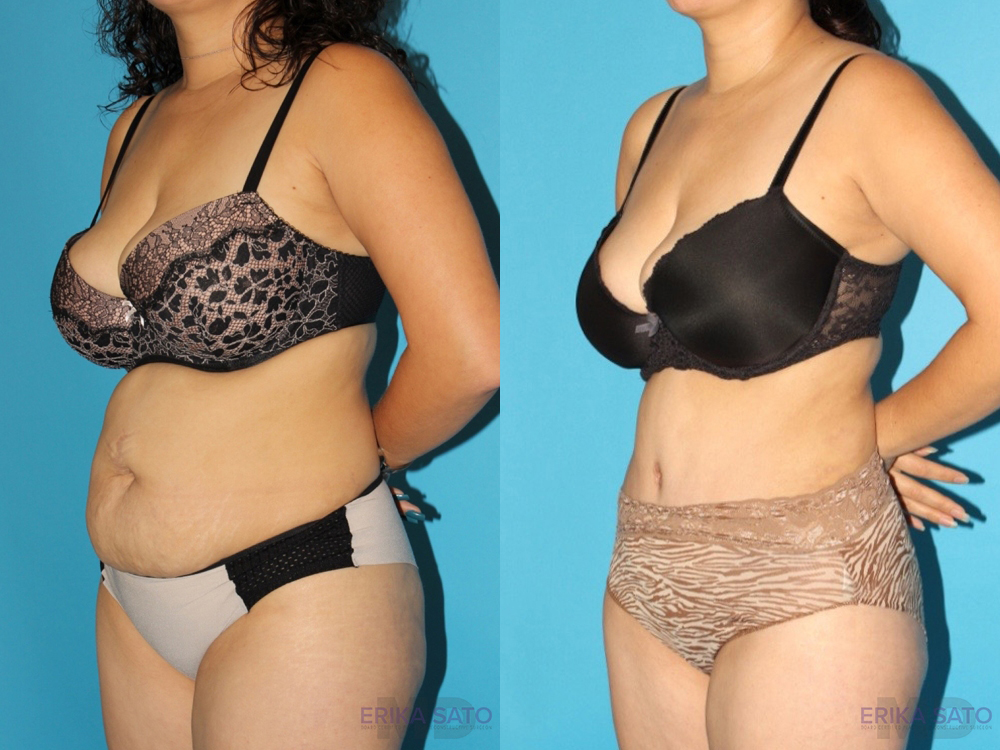 Tummy Tuck case #7166