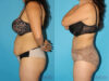 Tummy Tuck case #7166 slider thumbnail