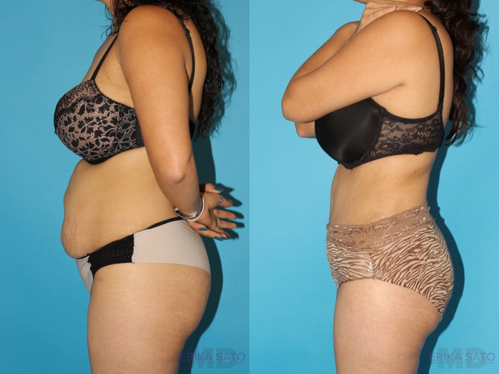 Tummy Tuck case #7166