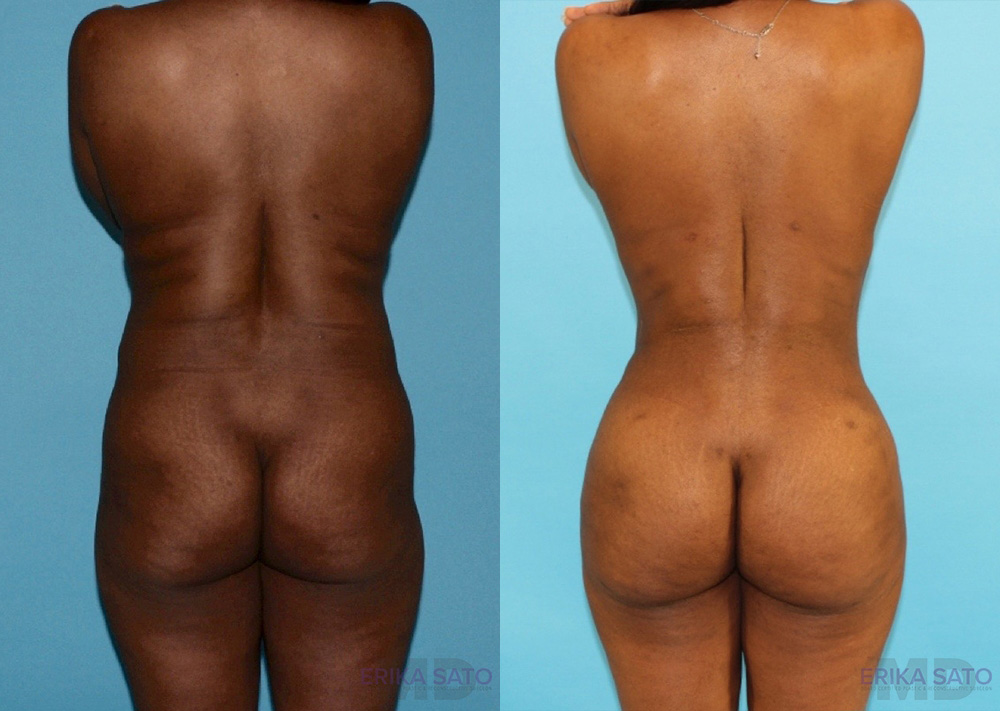 Brazilian Butt Lift case #4633