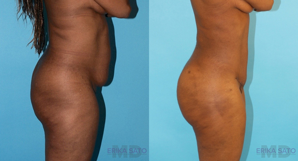 Brazilian Butt Lift case #4633