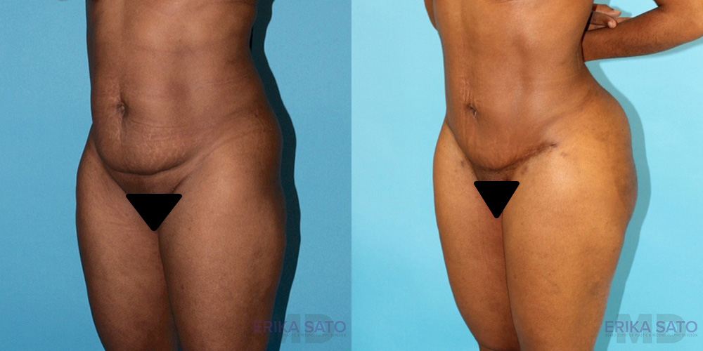 Brazilian Butt Lift case #4633