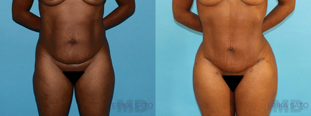 Brazilian Butt Lift case #4633