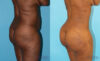 Brazilian Butt Lift case #4633 slider thumbnail