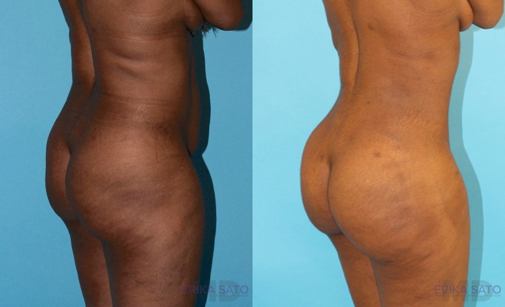 Brazilian Butt Lift case #4633