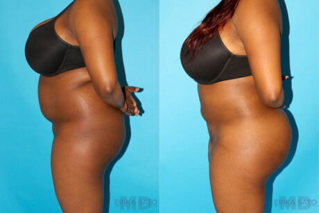 Brazilian Butt Lift case #4641