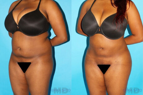 Brazilian Butt Lift case #4641