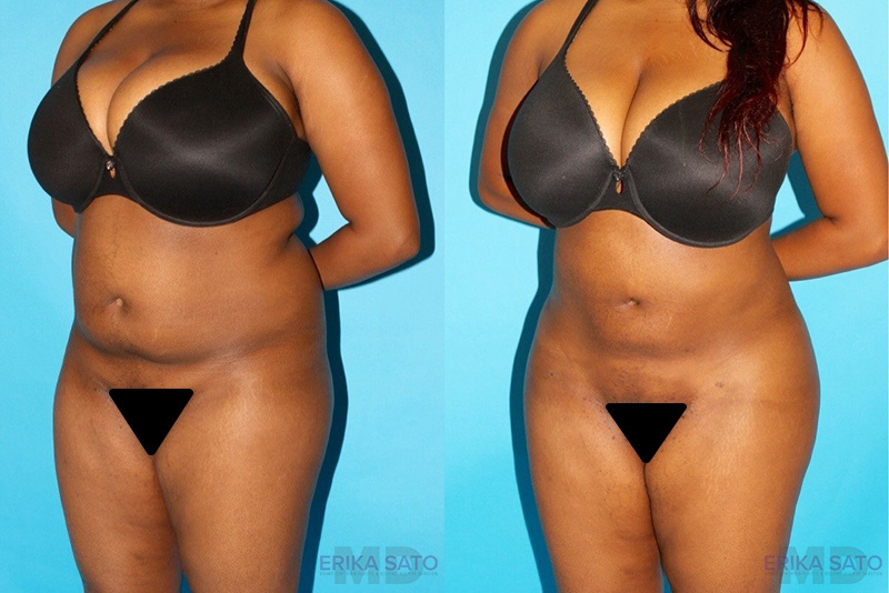 Brazilian Butt Lift case #4641