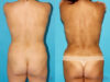 Liposuction case #5886 slider thumbnail