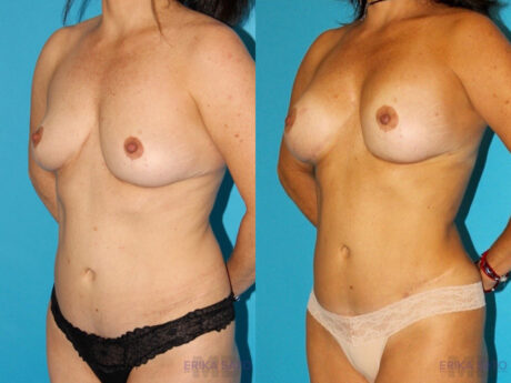Liposuction case #5886