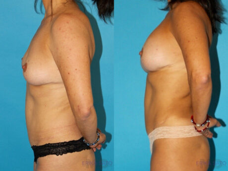 Liposuction case #5886