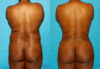 Brazilian Butt Lift case #4642 slider thumbnail