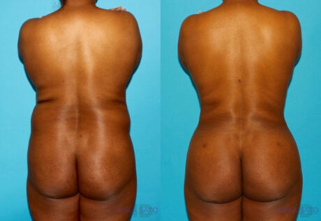 Brazilian Butt Lift case #4642