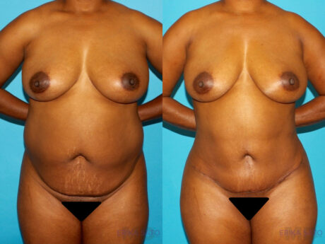 Brazilian Butt Lift case #4642