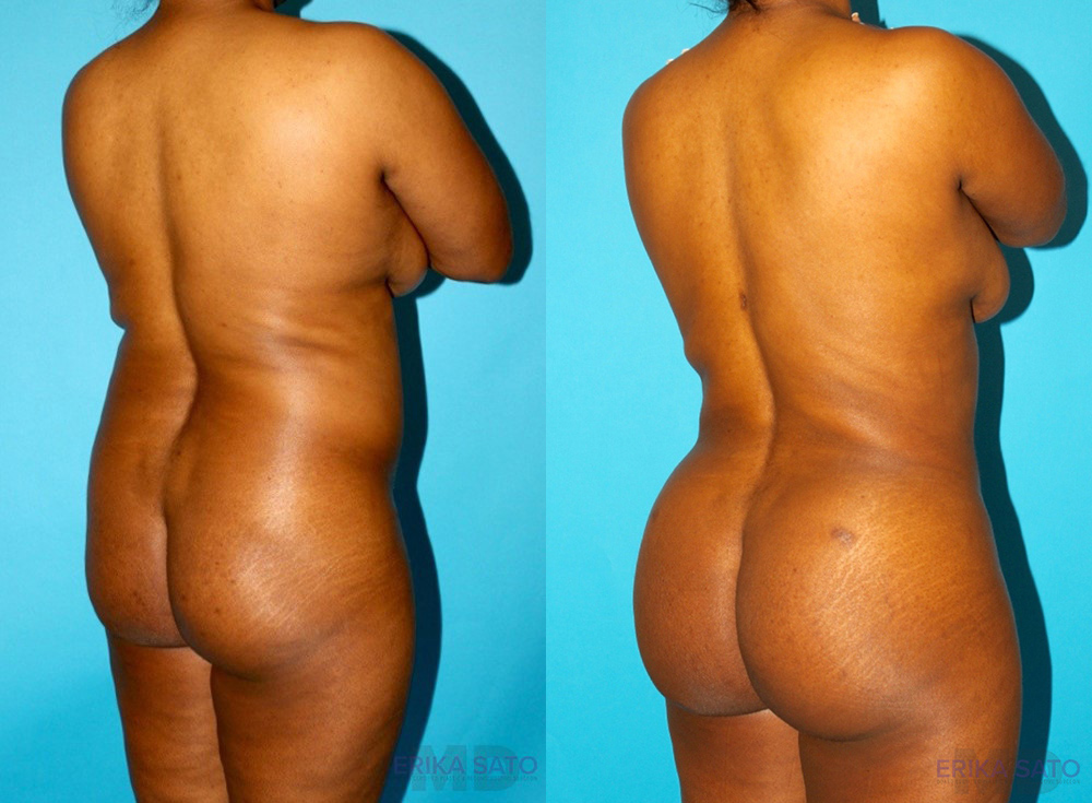 Brazilian Butt Lift case #4642