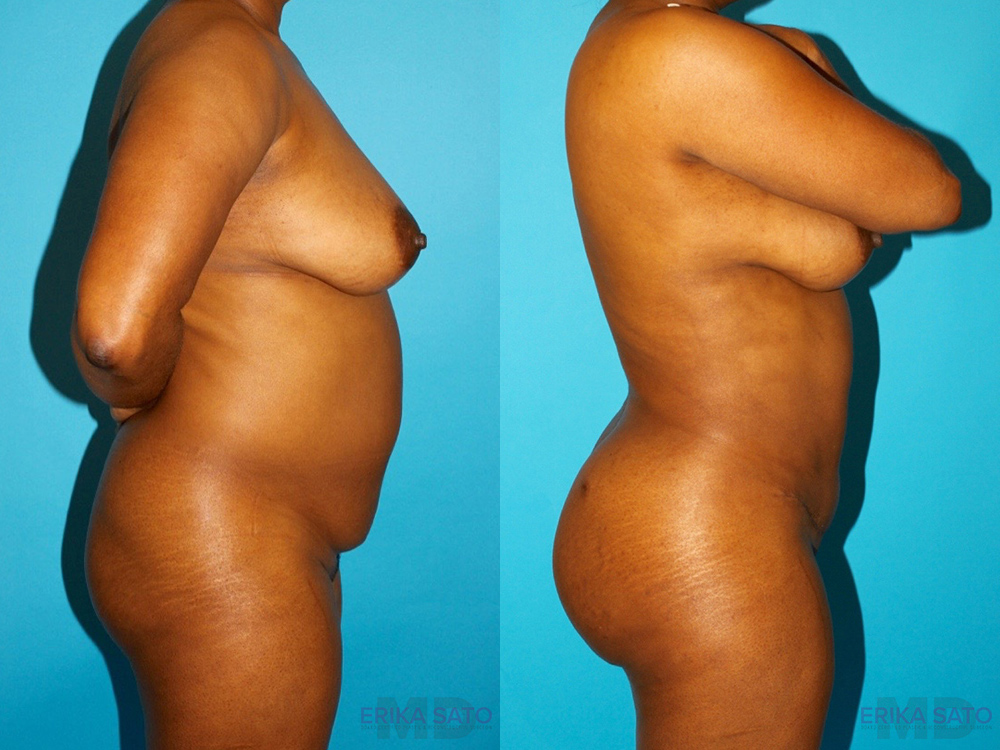 Brazilian Butt Lift case #4642