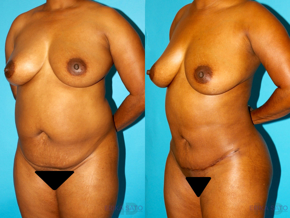 Brazilian Butt Lift case #4642