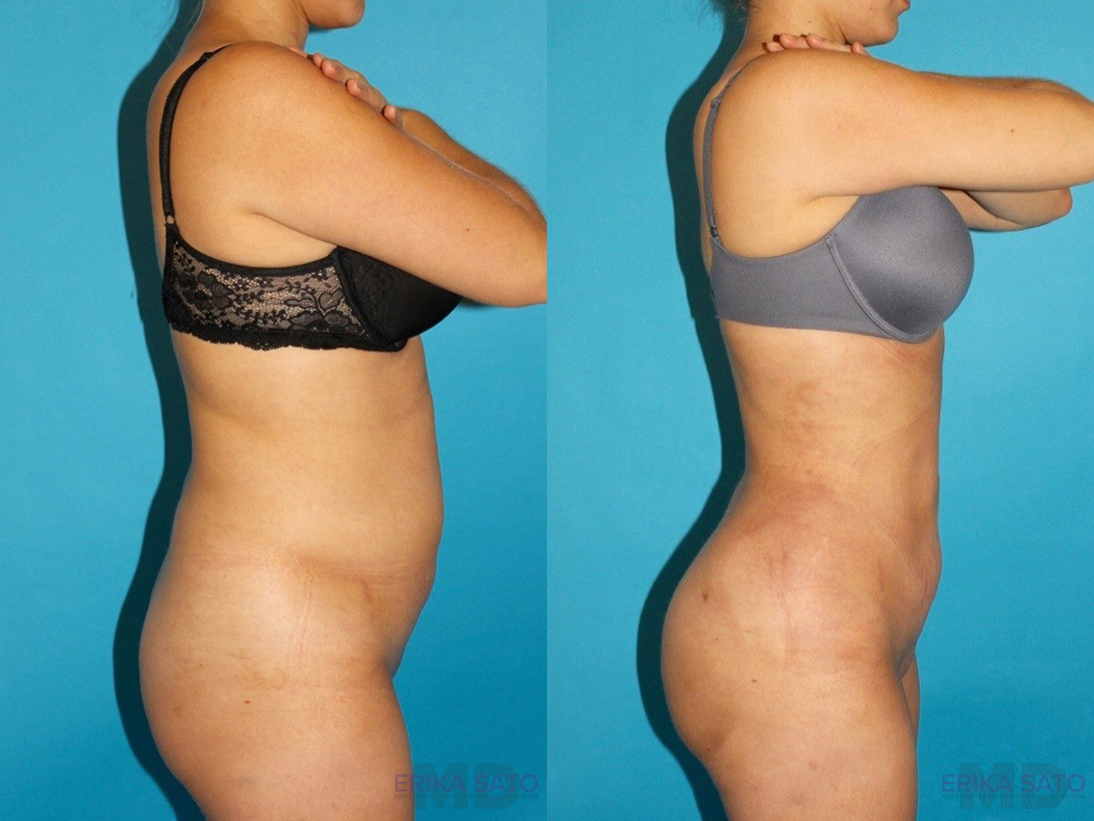 Brazilian Butt Lift case #4671