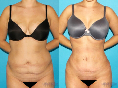 Brazilian Butt Lift case #4671