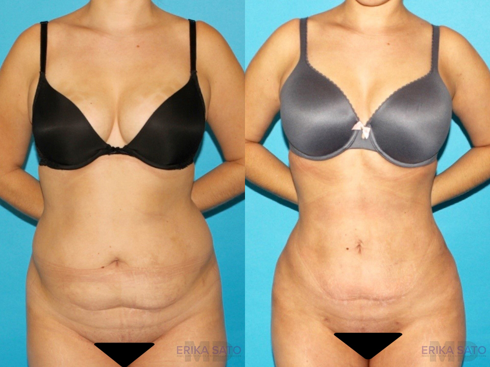 Brazilian Butt Lift case #4671