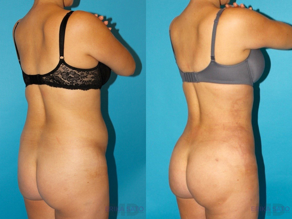 Brazilian Butt Lift case #4671