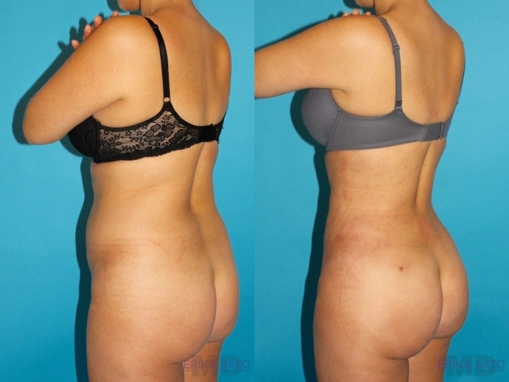Brazilian Butt Lift case #4671