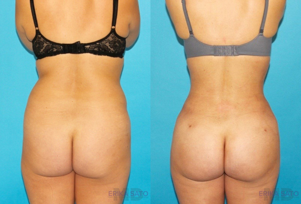 Brazilian Butt Lift case #4671