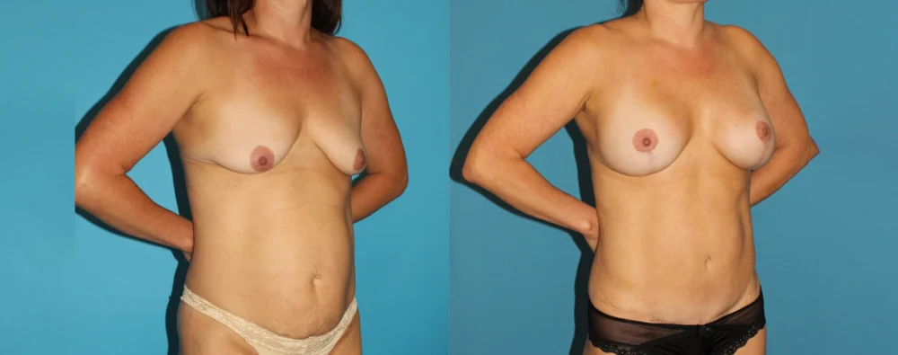 Mommy Makeover case #6506