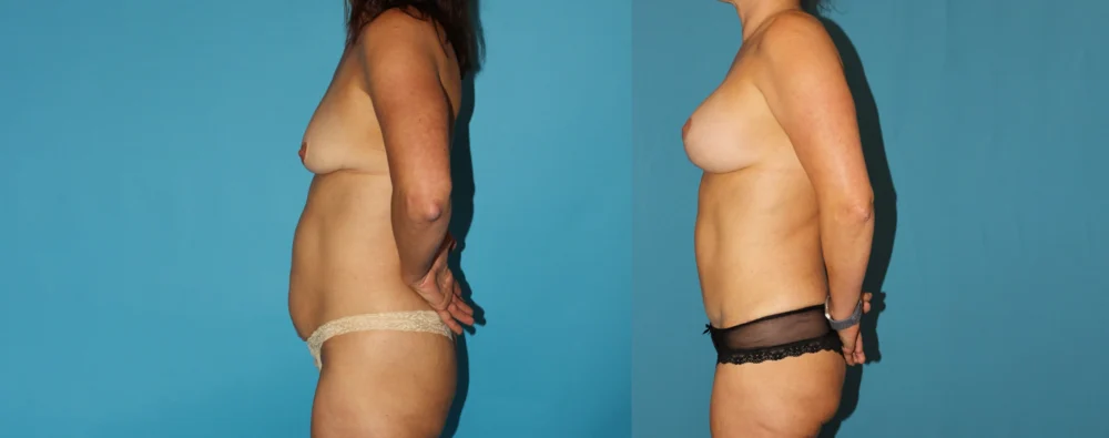 Mommy Makeover case #6506