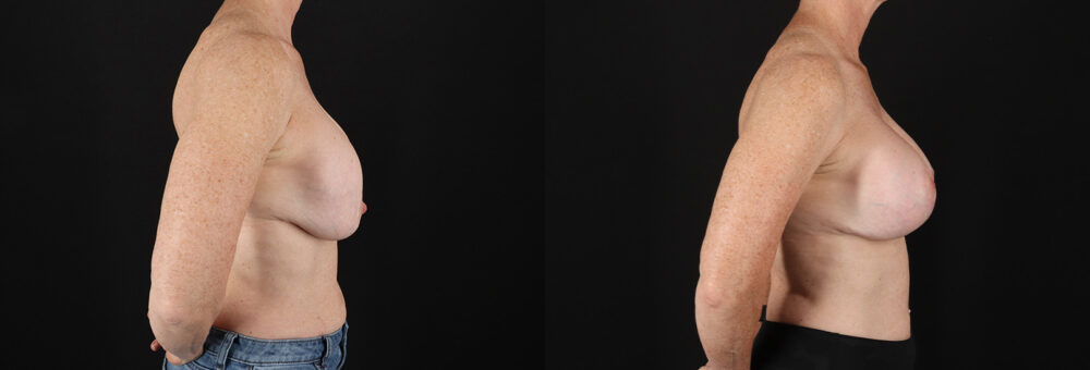 Revision Breast Surgery case #256267