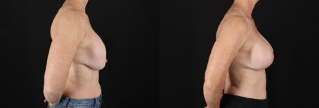 Revision Breast Surgery case #256267