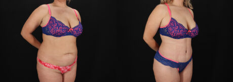 Tummy Tuck case #7775