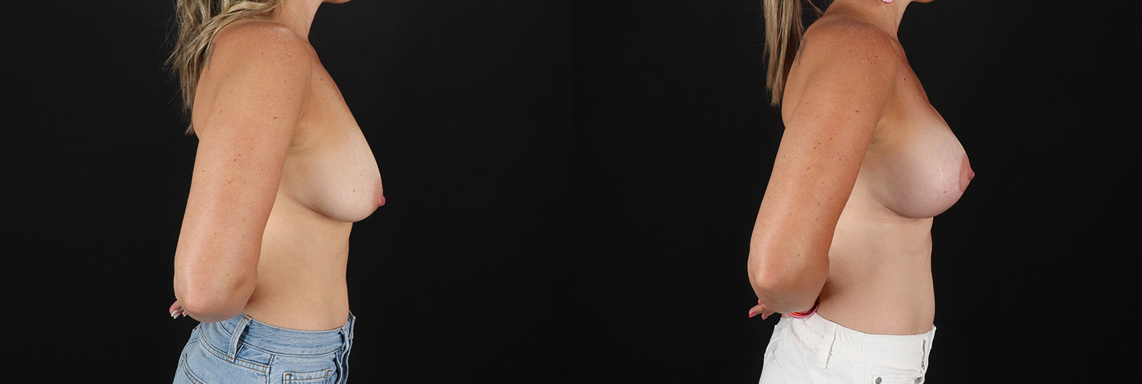 3-20139-77872-Breast-Lift-with-Implants-before-and-after-photo-by-Dr.-Erika-A.-Sato-in-Houston-TX