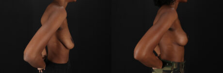 Breast Lift case #7806